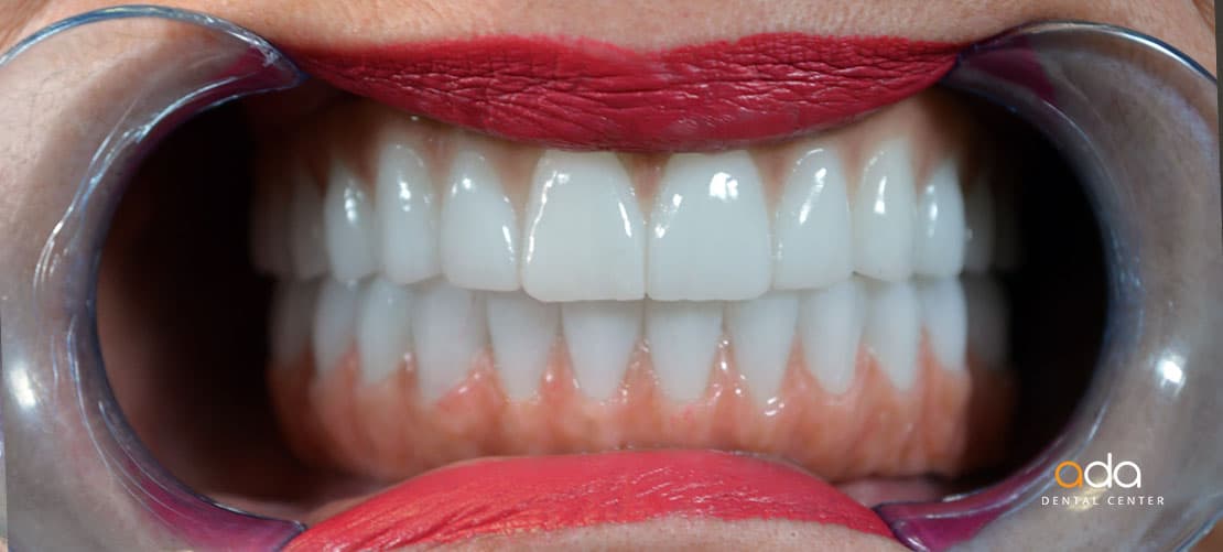 Implantologie — caz clinic înainte și după, Smile by Ada, Sector 2 București