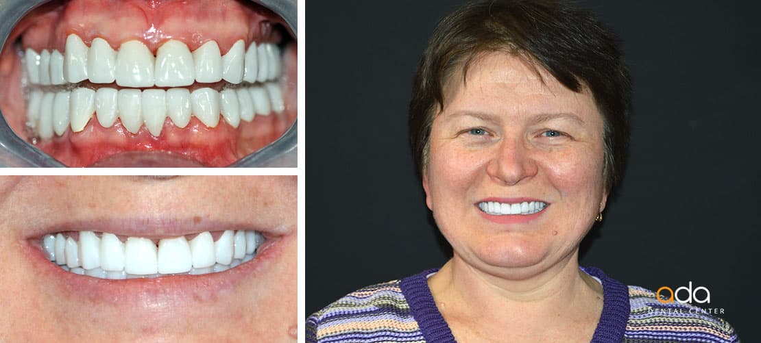 Digital Smile Design — caz clinic înainte și după, Smile by Ada, Sector 2 București