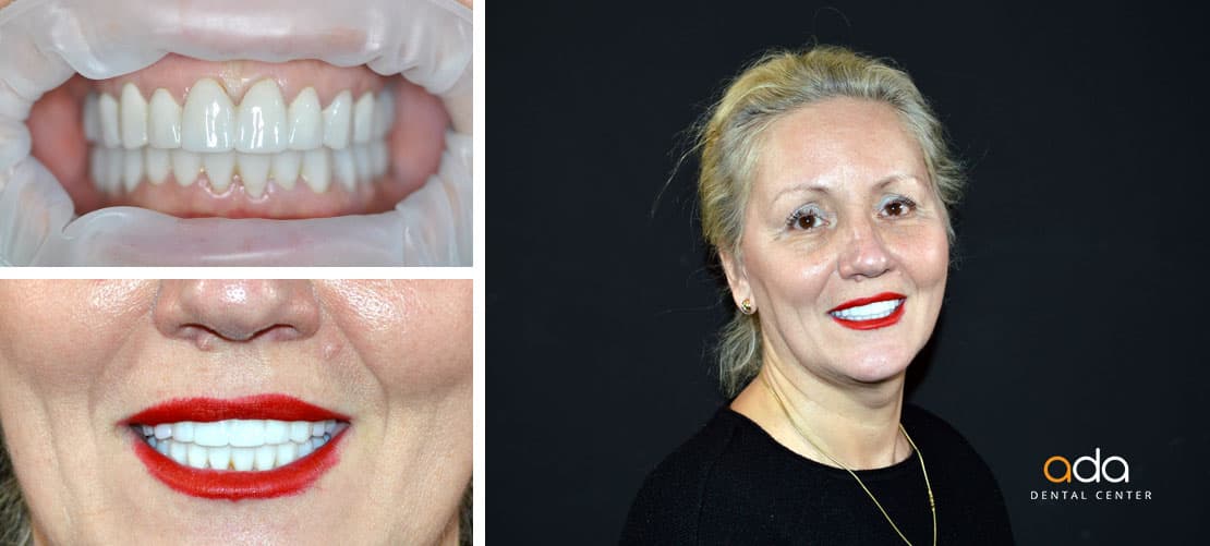 Digital Smile Design — caz clinic înainte și după, Smile by Ada, Sector 2 București