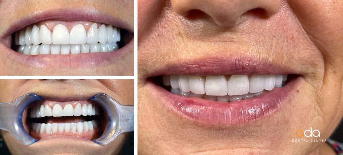 Digital Smile Design — caz clinic înainte și după, Smile by Ada, Sector 2 București