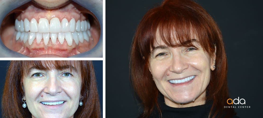 Digital Smile Design — caz clinic înainte și după, Smile by Ada, Sector 2 București