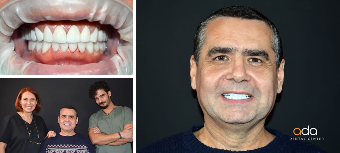 Digital Smile Design — caz clinic înainte și după, Smile by Ada, Sector 2 București