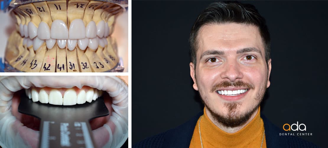 Digital Smile Design — caz clinic înainte și după, Smile by Ada, Sector 2 București
