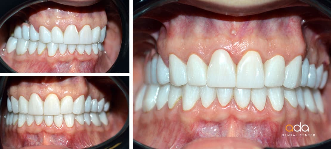 Digital Smile Design — caz clinic înainte și după, Smile by Ada, Sector 2 București