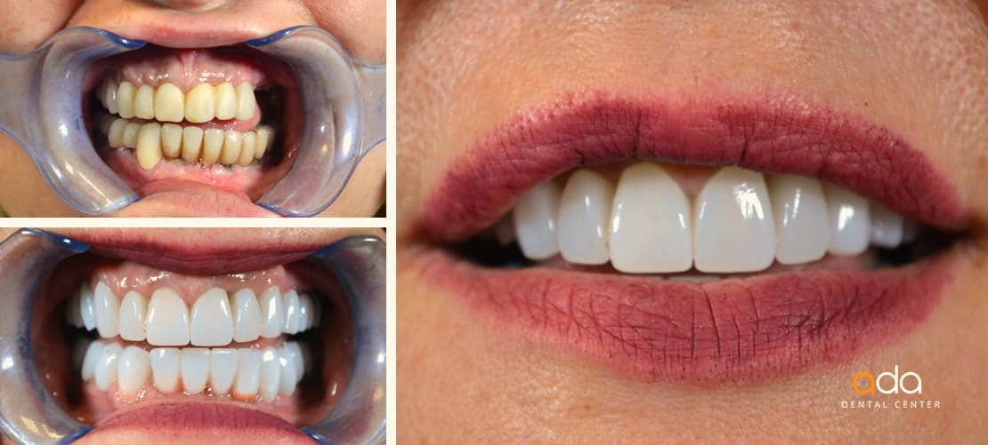 Implantologie — caz clinic înainte și după, Smile by Ada, Sector 2 București