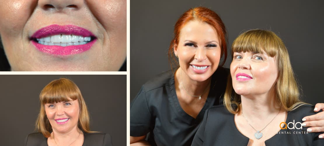 Implantologie — caz clinic înainte și după, Smile by Ada, Sector 2 București