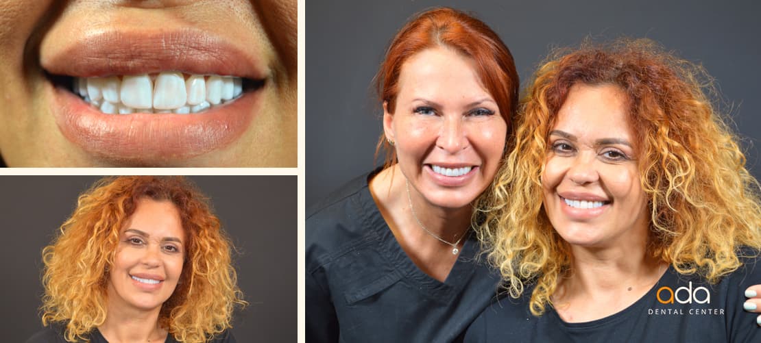 Digital Smile Design — caz clinic înainte și după, Smile by Ada, Sector 2 București