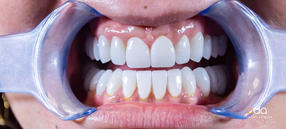 Reabilitare completă — caz clinic înainte și după, Smile by Ada, Sector 2 București