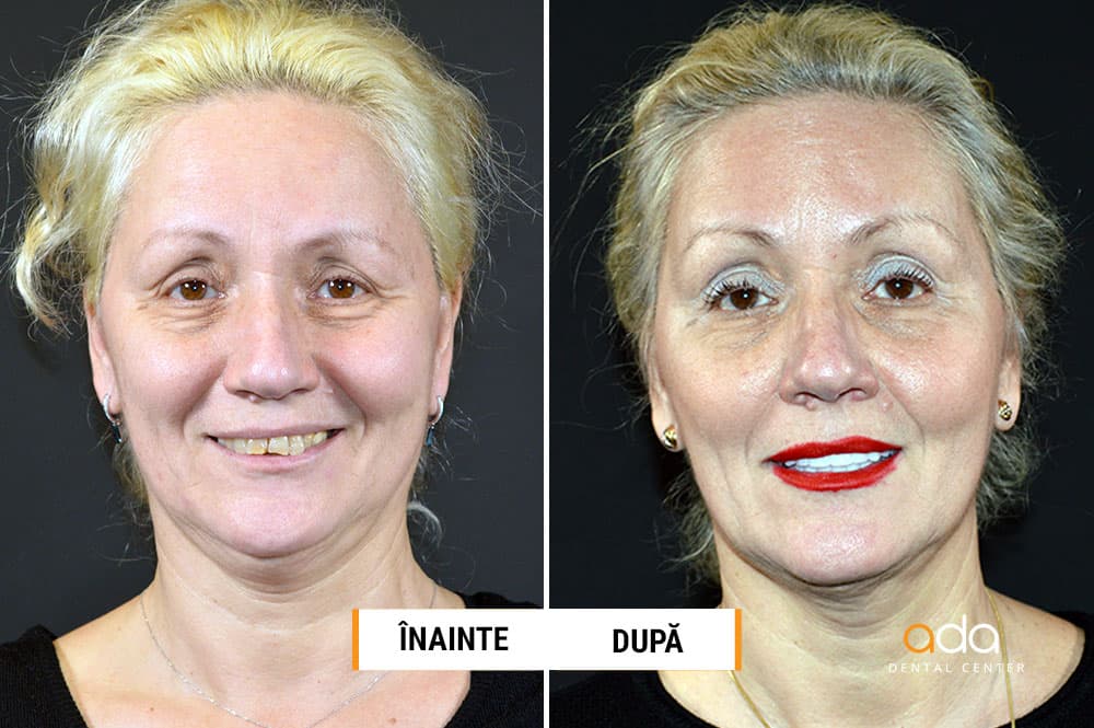 Digital Smile Design — imagine din tratament, Smile by Ada, Sector 2 București — foto 2