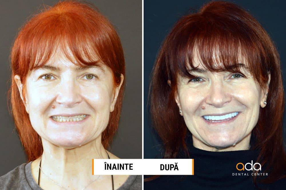 Digital Smile Design — imagine din tratament, Smile by Ada, Sector 2 București — foto 1
