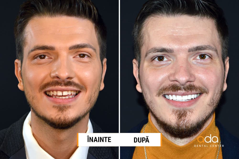 Digital Smile Design — imagine din tratament, Smile by Ada, Sector 2 București — foto 1