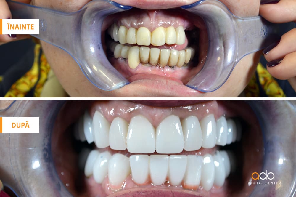 Reabilitare completă — imagine din tratament, Smile by Ada, Sector 2 București — foto 2