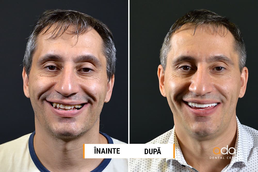 Digital Smile Design — imagine din tratament, Smile by Ada, Sector 2 București — foto 2