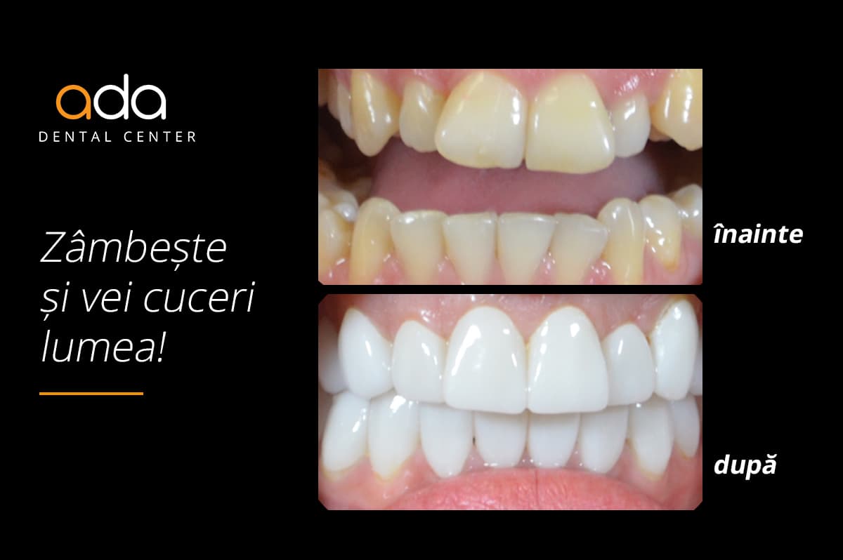 Digital Smile Design — imagine din tratament, Smile by Ada, Sector 2 București — foto 4