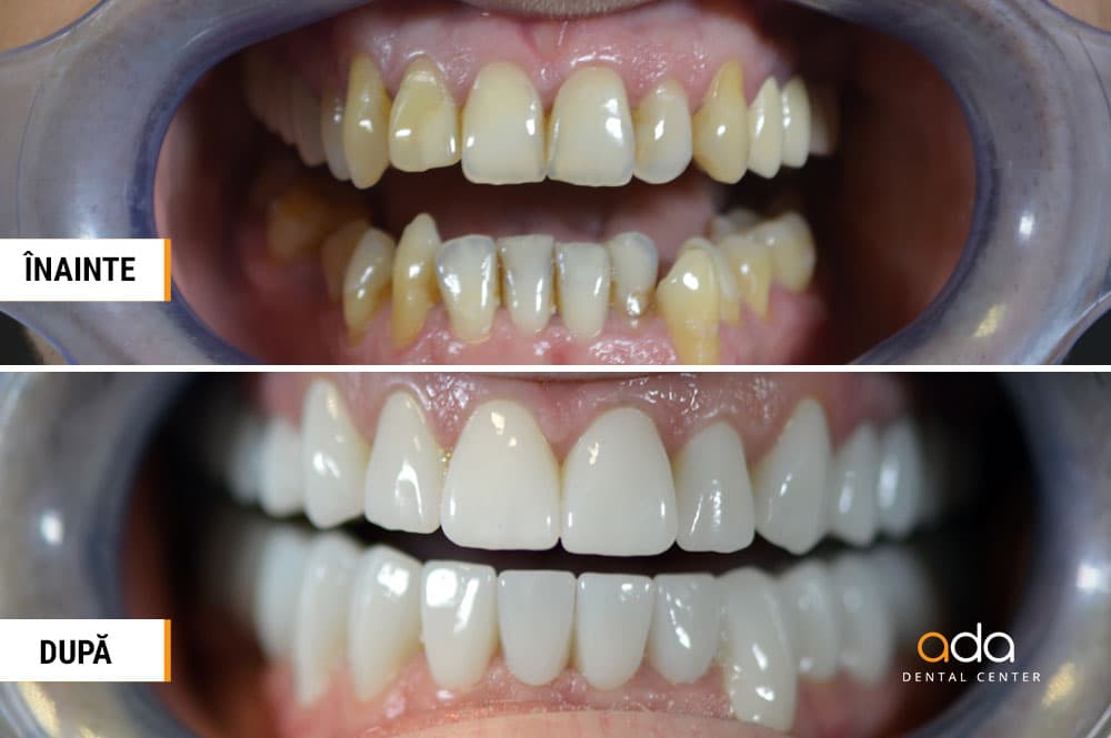 Reabilitare completă — imagine din tratament, Smile by Ada, Sector 2 București — foto 1