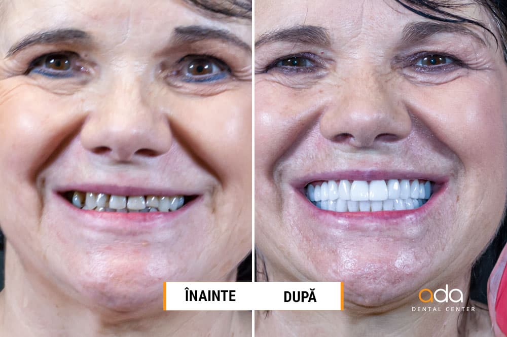 Reabilitare completă — imagine din tratament, Smile by Ada, Sector 2 București — foto 2