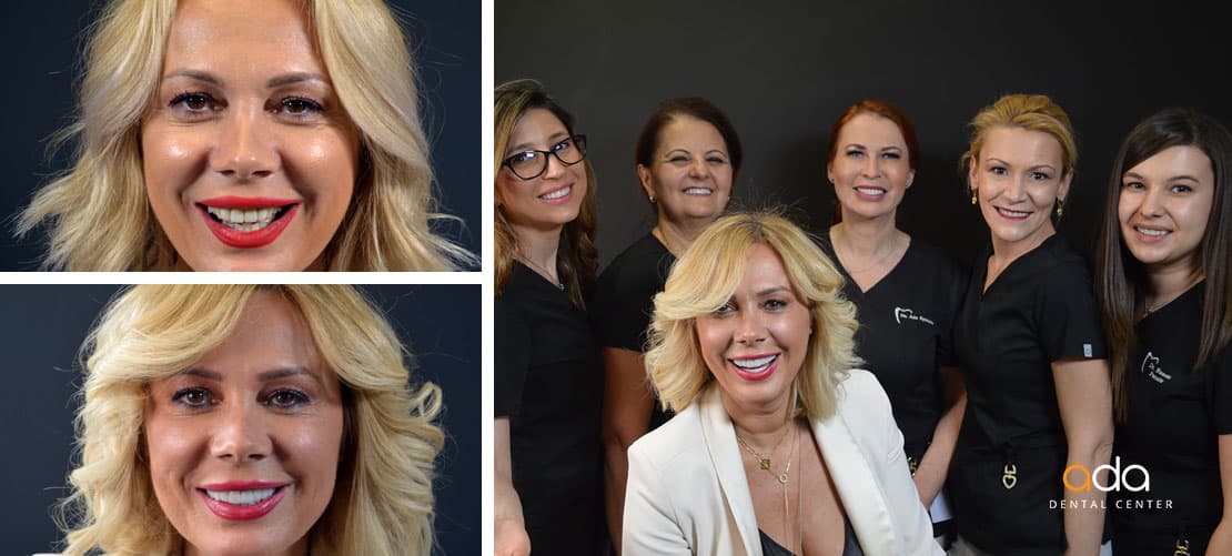 Digital Smile Design — caz clinic înainte și după, Smile by Ada, Sector 2 București