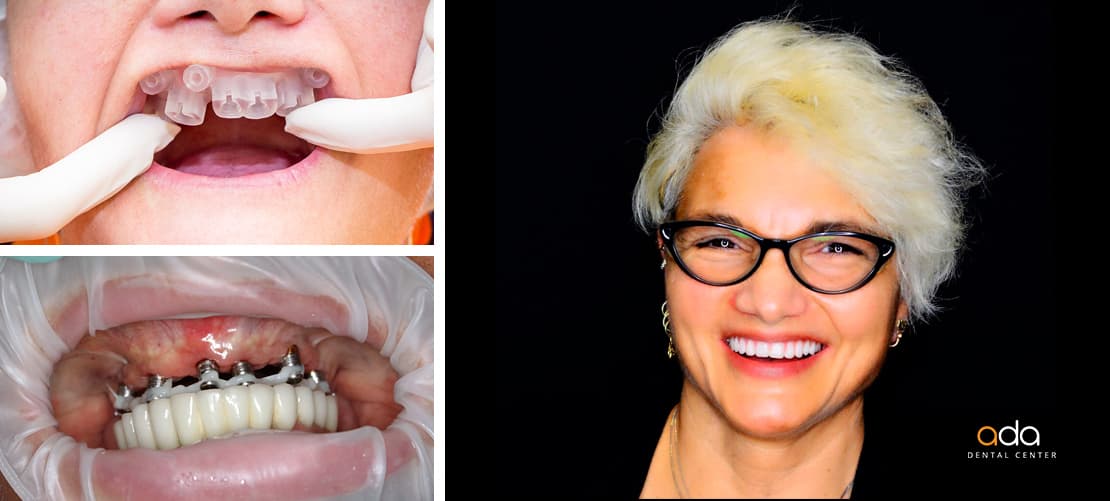 Implantologie — caz clinic înainte și după, Smile by Ada, Sector 2 București