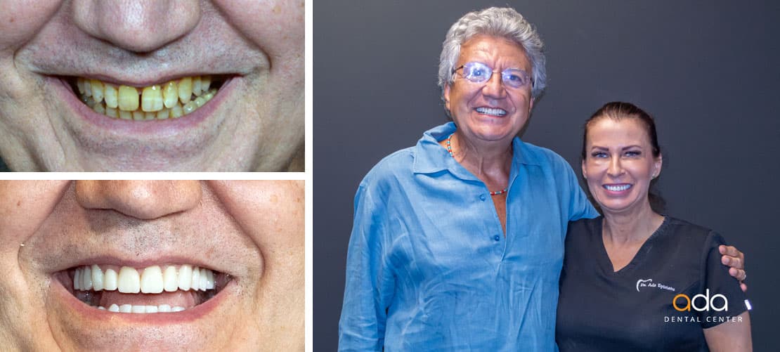 Estetică dentară — caz clinic înainte și după, Smile by Ada, Sector 2 București