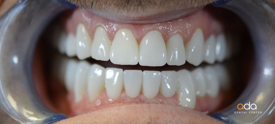 Reabilitare completă — caz clinic înainte și după, Smile by Ada, Sector 2 București