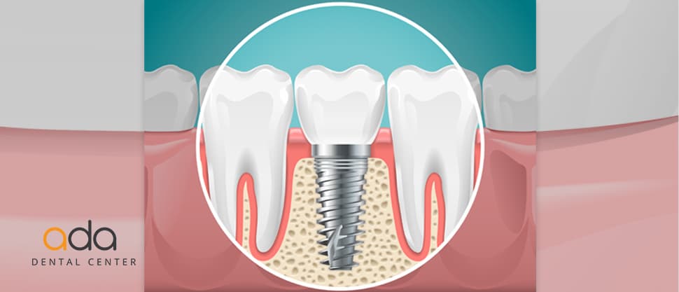 De ce implant? Fortele din masticatie dau raspunsul biologic.