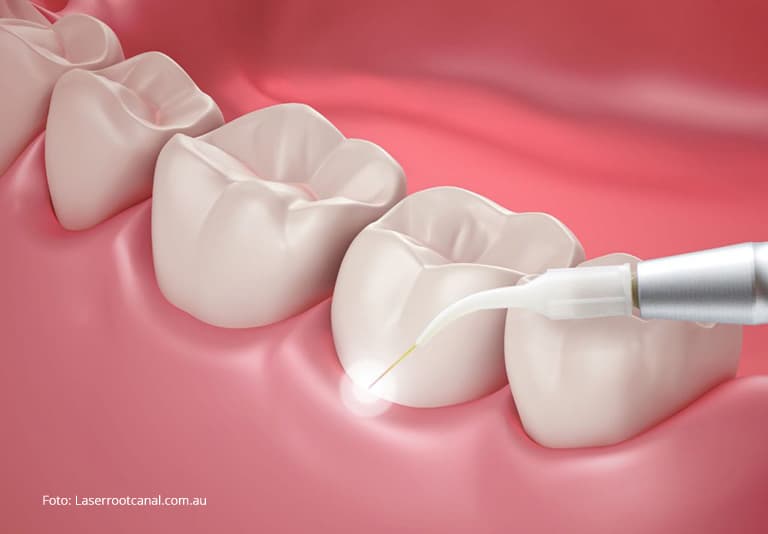 Tratamentul chirurgical cu laser