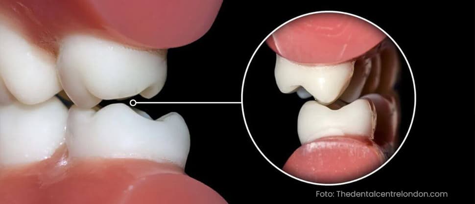 Bruxism: cauze, simptome, tratament. De ce scrâșnitul dinților se poate transforma într-o afecțiune severă