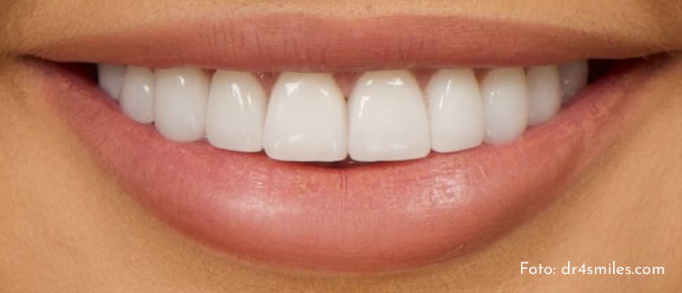 Fațetele dentare: caracteristici și avantaje. Bucură-te de un zâmbet perfect