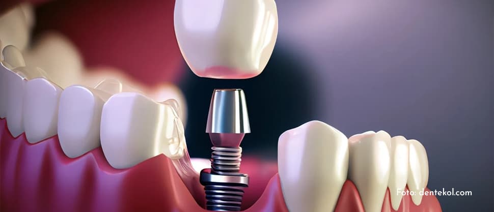 Implantul dentar și boala parodontală