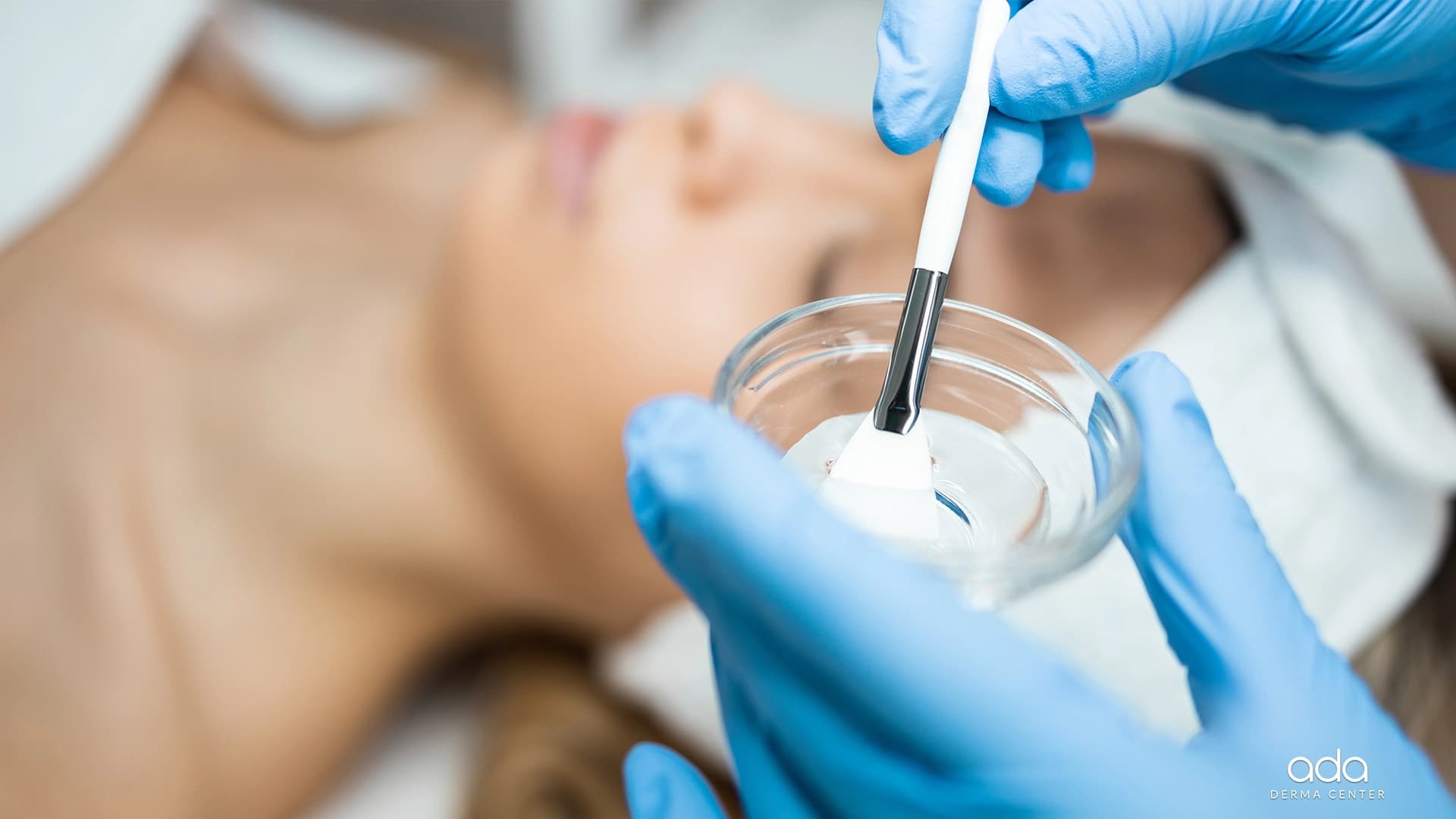 Tipuri de peeling chimic: glicolic, lactic, salicilic