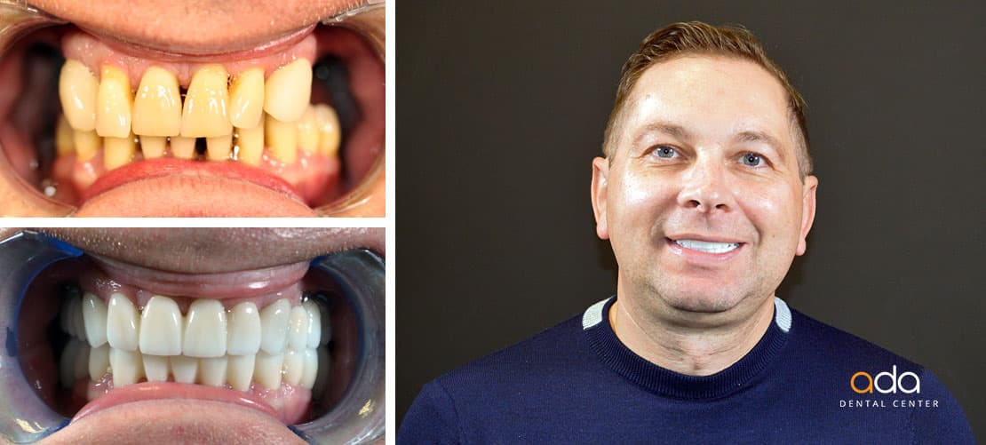 Implantologie — caz clinic înainte și după, Smile by Ada, Sector 2 București