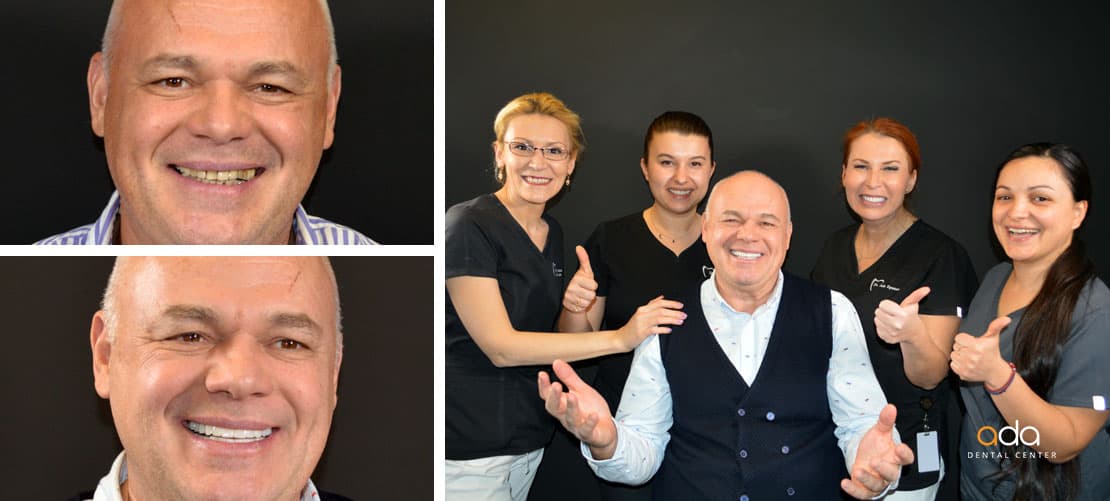 Coroane zirconiu — caz clinic înainte și după, Smile by Ada, Sector 2 București